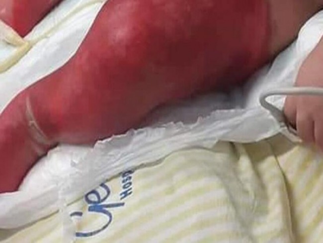 Enfermeira é suspeita de ter dado banho de 50º C em bebê