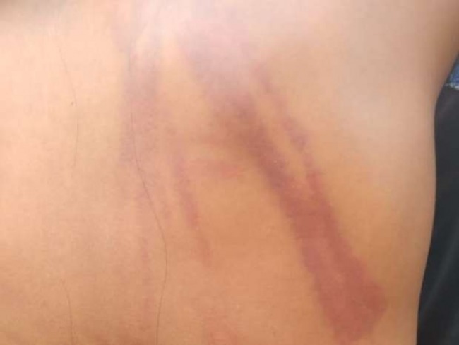 Menina de 12 anos  surrada pelo pai com mangueirada nas costas: 'dei apenas um corretivo'