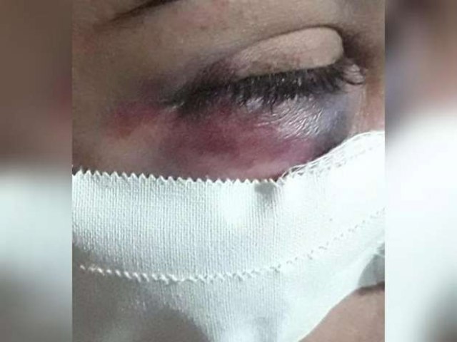 Mulher  agredida pelo marido com soco no rosto e tem ferimento no nariz