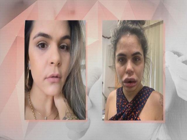 Mulheres denunciam dentista aps harmonizao facial; fotos mostram rostos deformados