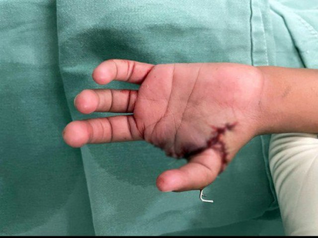 Com 4 dedos, menino ganha novo polegar após transplante do indicador 