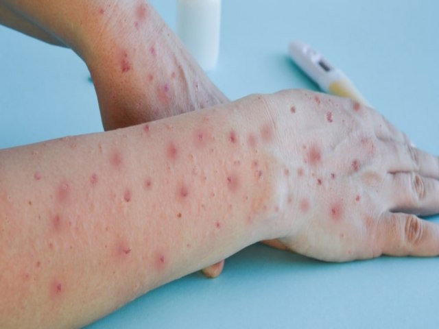 Jovem de 17 anos  diagnosticado com vrus Monkeypox em Sidrolndia