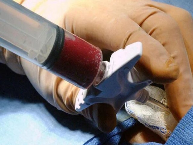 Paciente americana  curada do HIV aps transplante de clulas-tronco