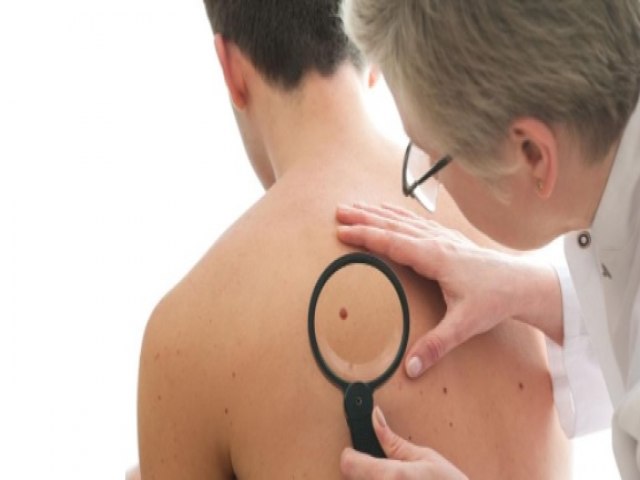 CERCA DE 2 MIL PESSOAS DEVEM MORRER POR CAUSA DO MELANOMA ESTE ANO