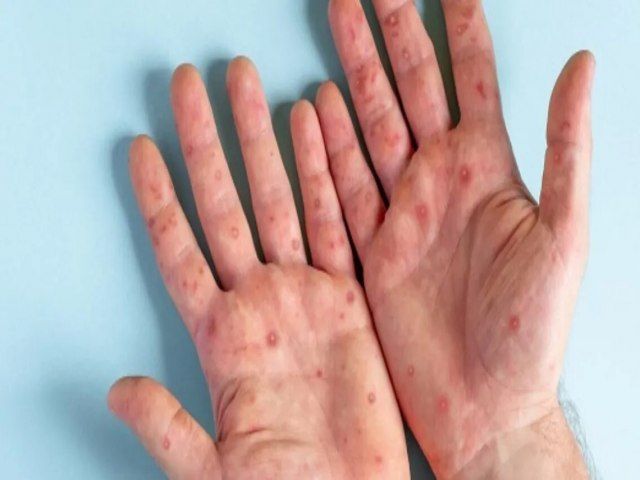 SERGIPE REGISTRA 13 NOVOS CASOS DE MONKEYPOX E CHEGA A S 66 CASOS