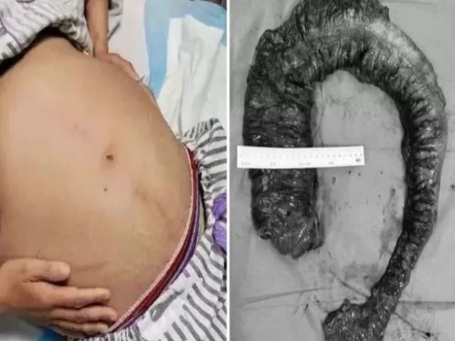 Paciente  submetida a cirurgia para retirar massa fecal de 1m e 20kg que endureceu aps constipao