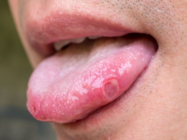 Afta na l�ngua: sintomas, causas e tratamento