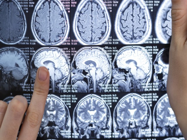 AVC: Acidente Vascular Cerebral causou quase 89 mil mortes no pas em 2023