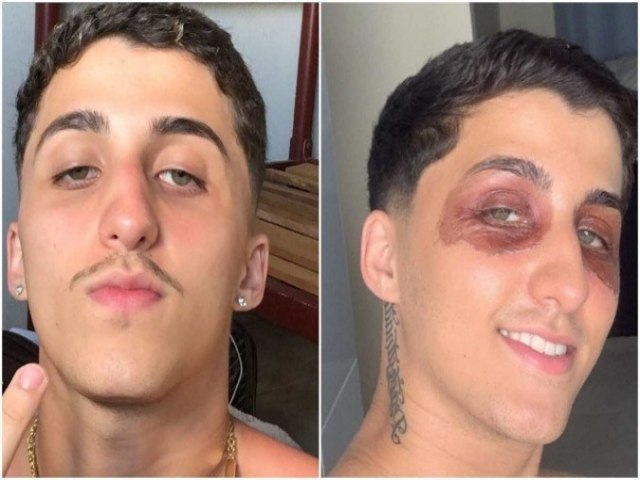 Jovem acorda com hematomas e inchao nos olhos sem saber o motivo