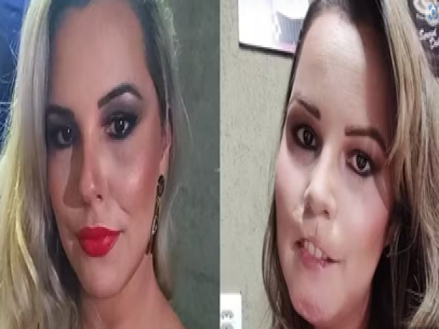 Mulher perde o lbio superior aps realizar harmonizao facial