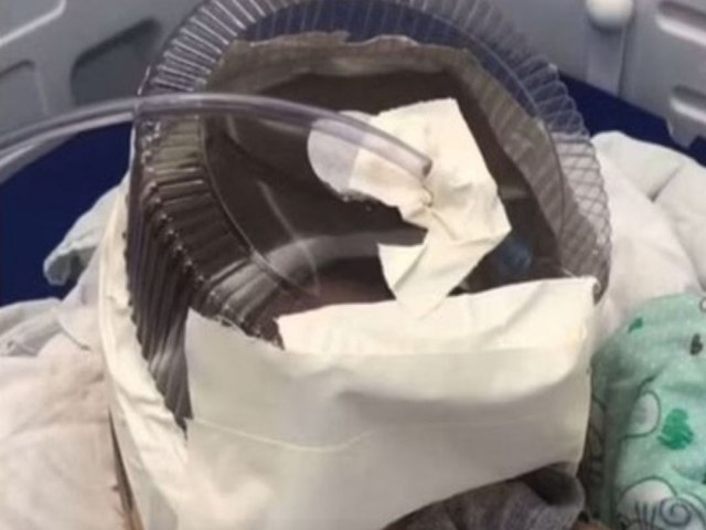 Hospital do Rio Grande do Norte usa embalagem de bolo como mscara de oxignio em beb