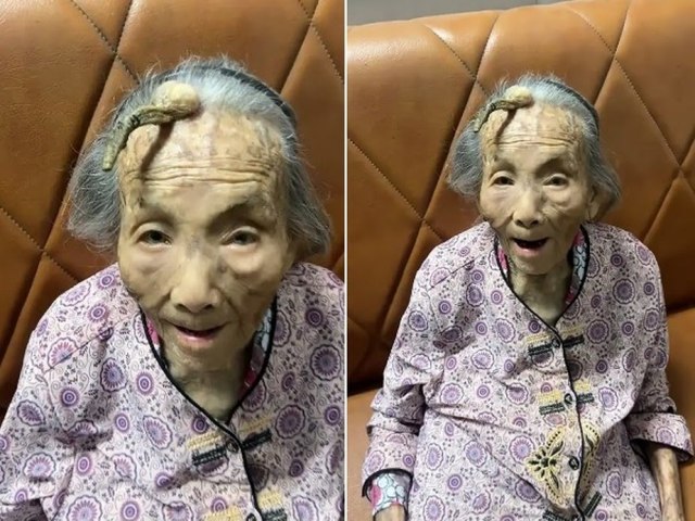 Idosa de 107 anos desperta ateno por chifre crescendo na testa