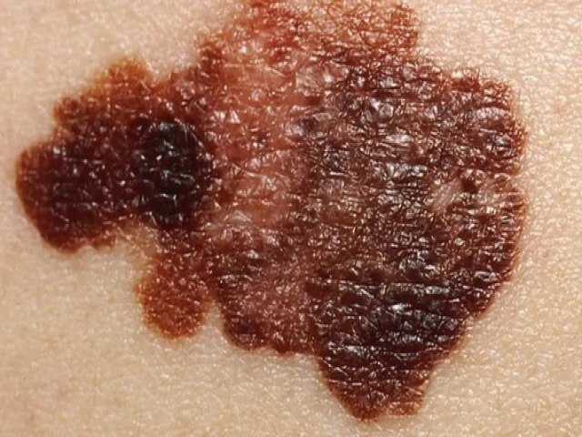 C�ncer de pele: como identificar se pintas, manchas e outros sinais podem indicar doen�a